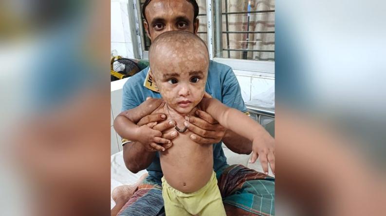 দুধ ও চিকিৎসার সহায়তা পেল অসুস্থ ৭ মাসের শিশু হুসাইন